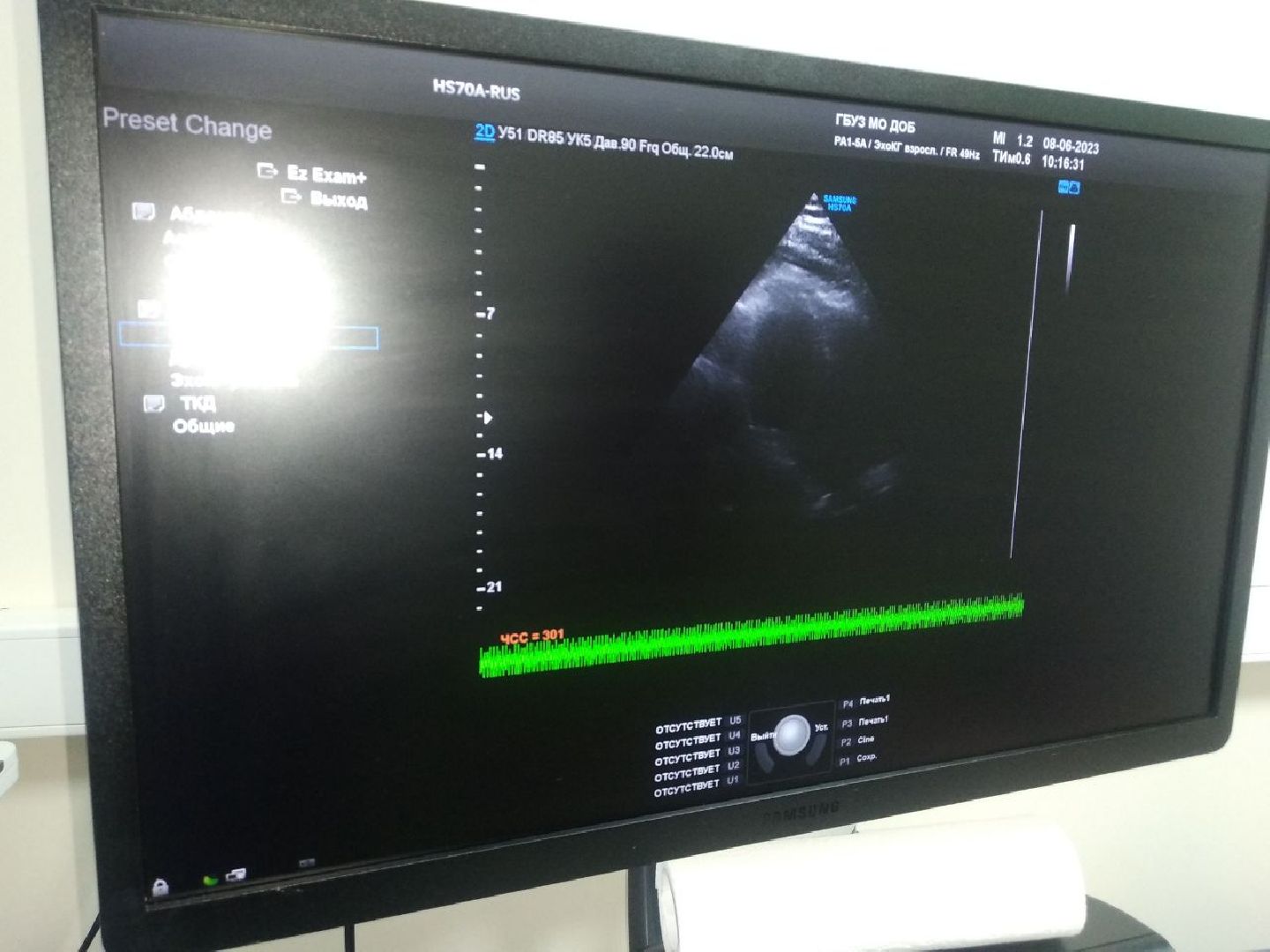 Дмитровская областная больница, Региональный сосудистый центр, Минздрав МО