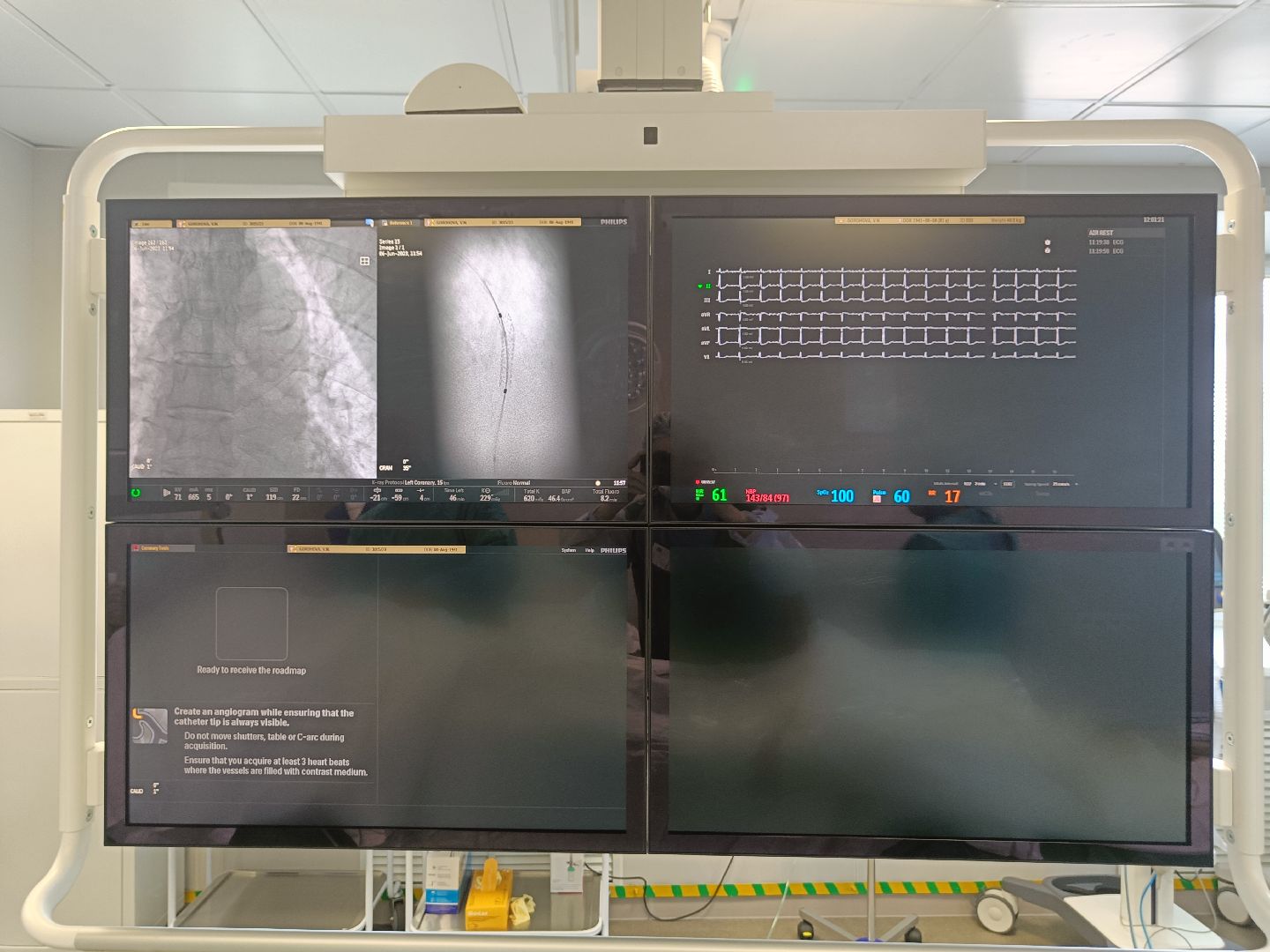 Операция, стентирование, сосудистый центр, ФБУЗ МСЧ №9 ФМБА России, Дубна