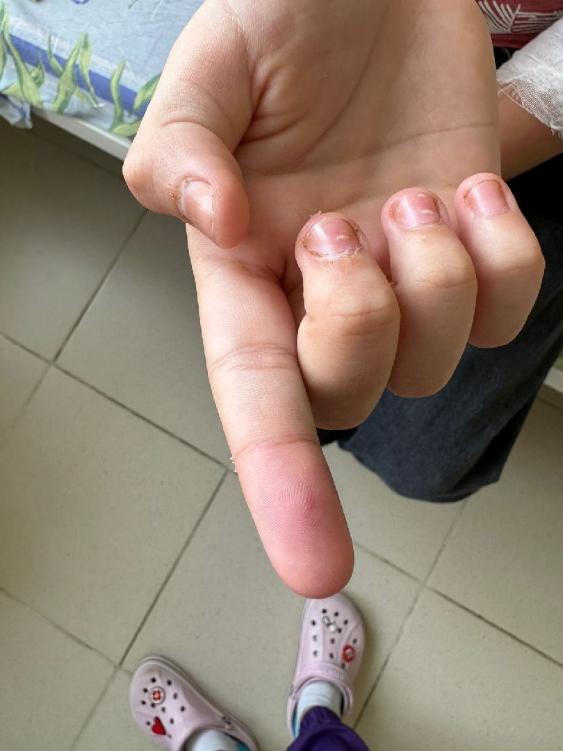 #гадюка, #талдом, #талдомскаяцрб, #советы, #медицина, #помощь