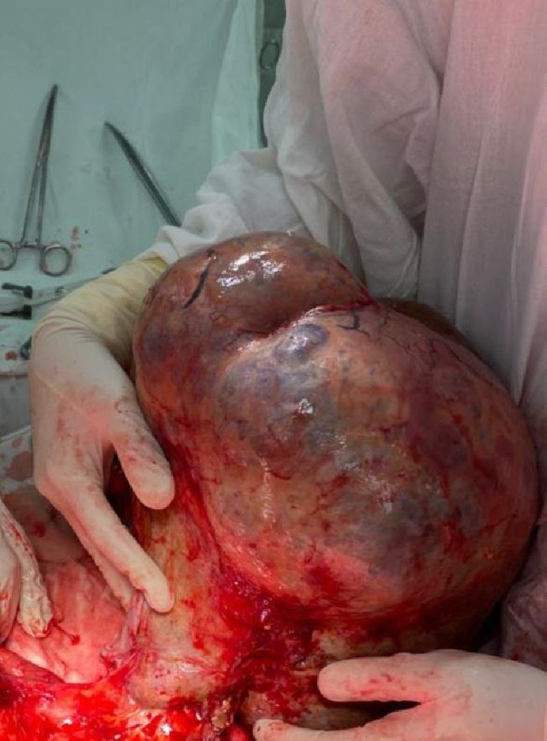 Балашиха, Подмосковье, медицина, онкология, МООД, гигантская опухоль