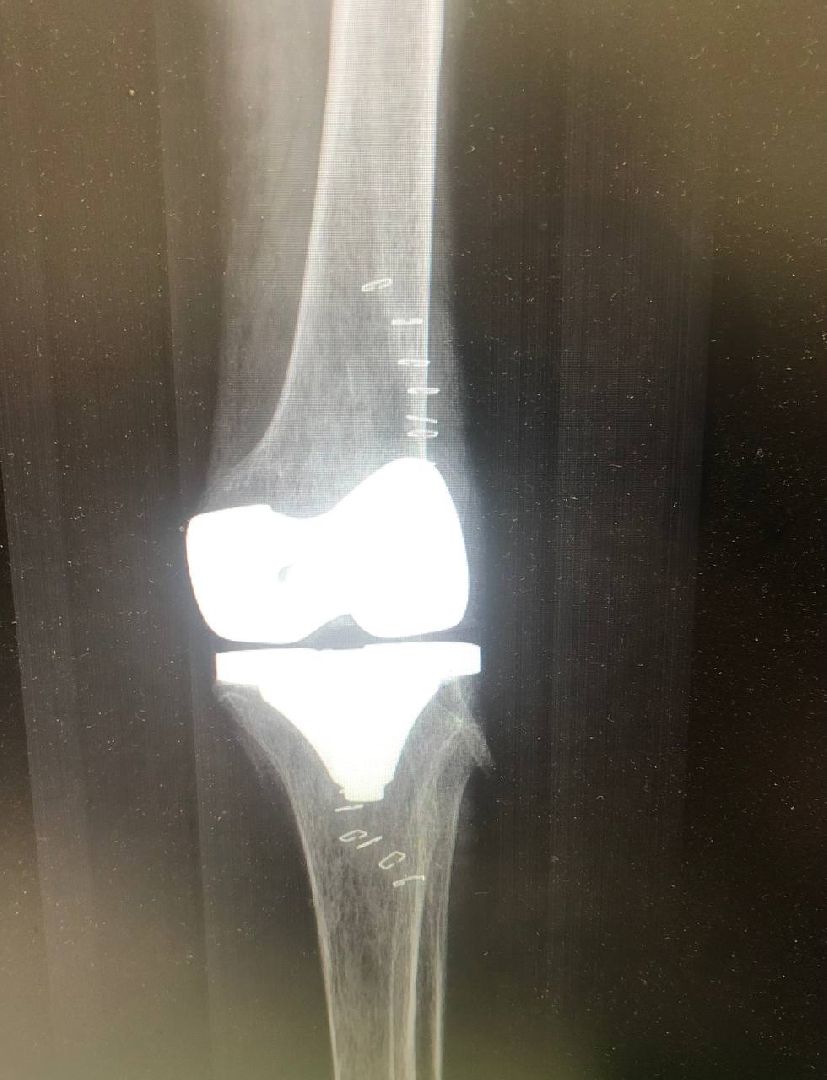 Истра, больница, операция, сустав, протезирование