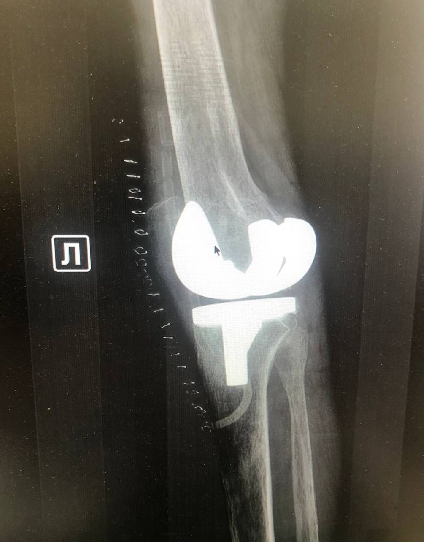 Истра, больница, операция, сустав, протезирование