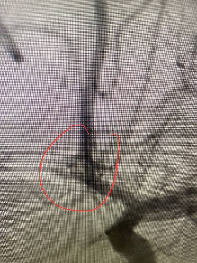 инсульт, юная, пациентка, ОКБ, Гегенава, Семёнов, Мартынович, Александра, операция, фенестарция, аневризма