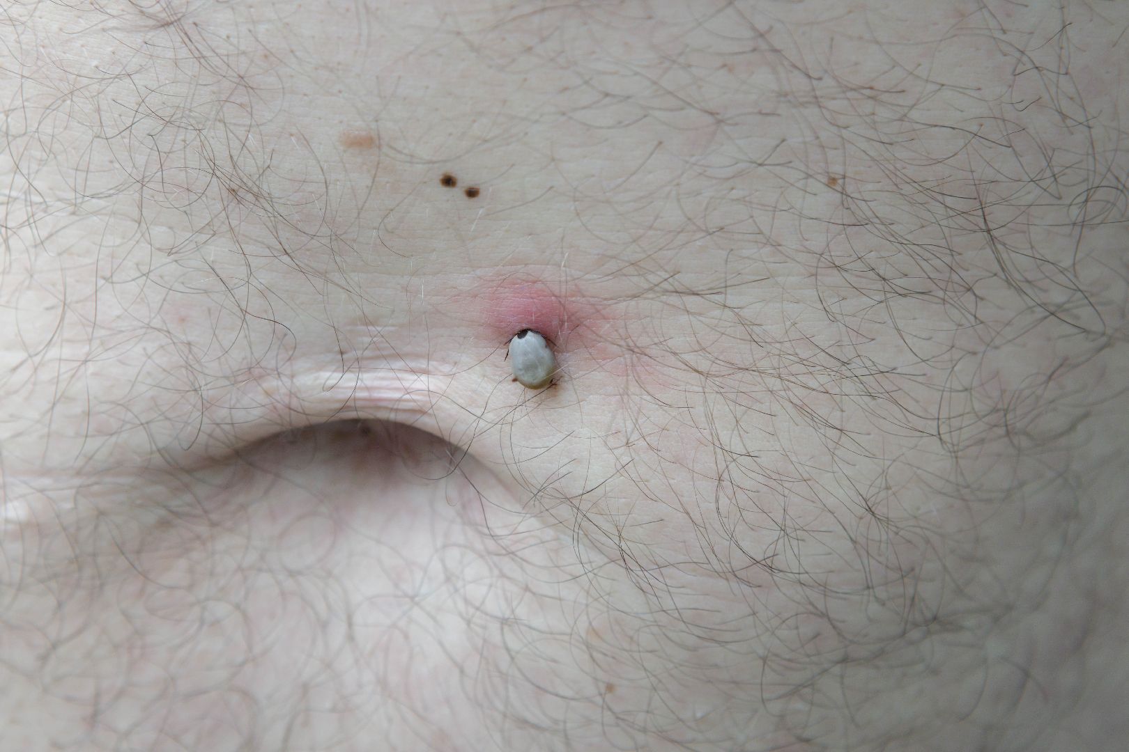 люберцы, клещи, травмпункт,