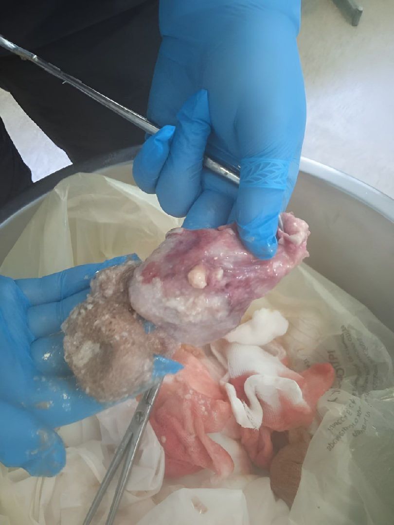 киста-чудовище, Домодедовская больница,