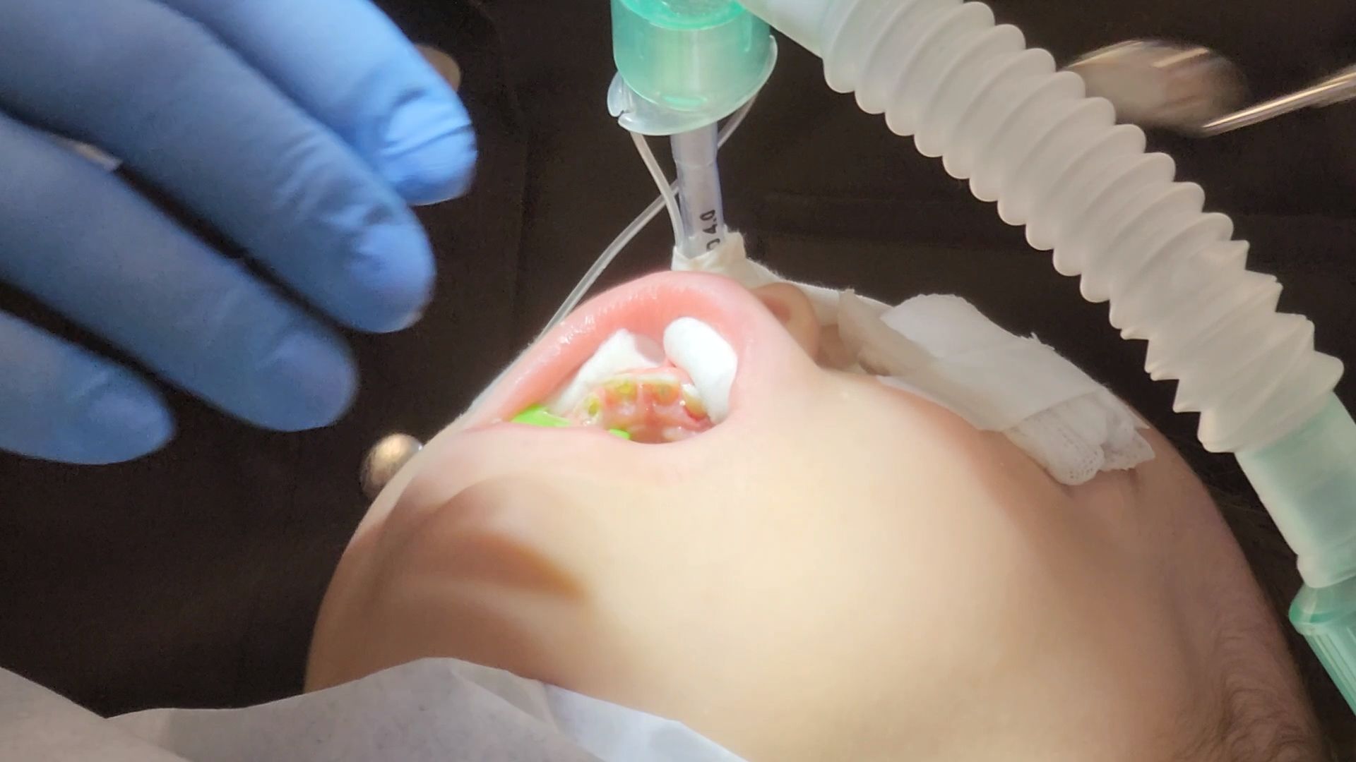 Одинцово, стоматология, наркоз, дети,