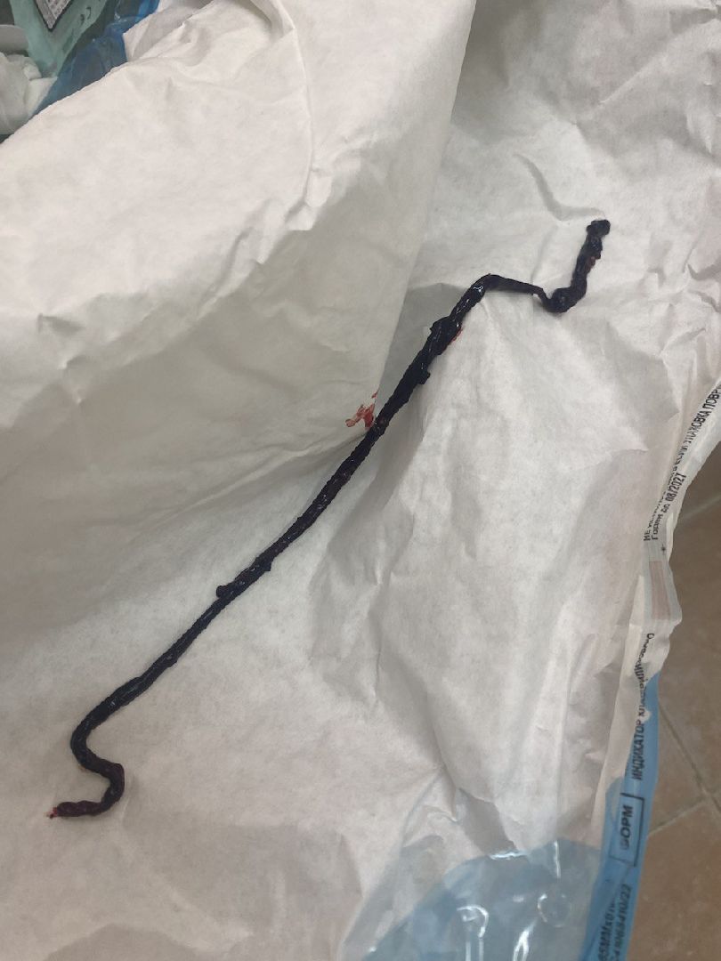 больница, врачи, хирургия, тромбоз, красногорск,