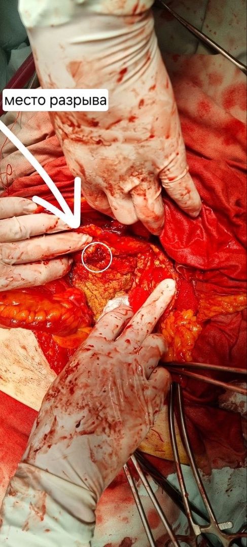 операция, сосудистый хирург, Владимир Никольский, Эдуард Семенов, Алена Матвеевская, Ильяз Мустафоев, анверизма, брюшная аорта,