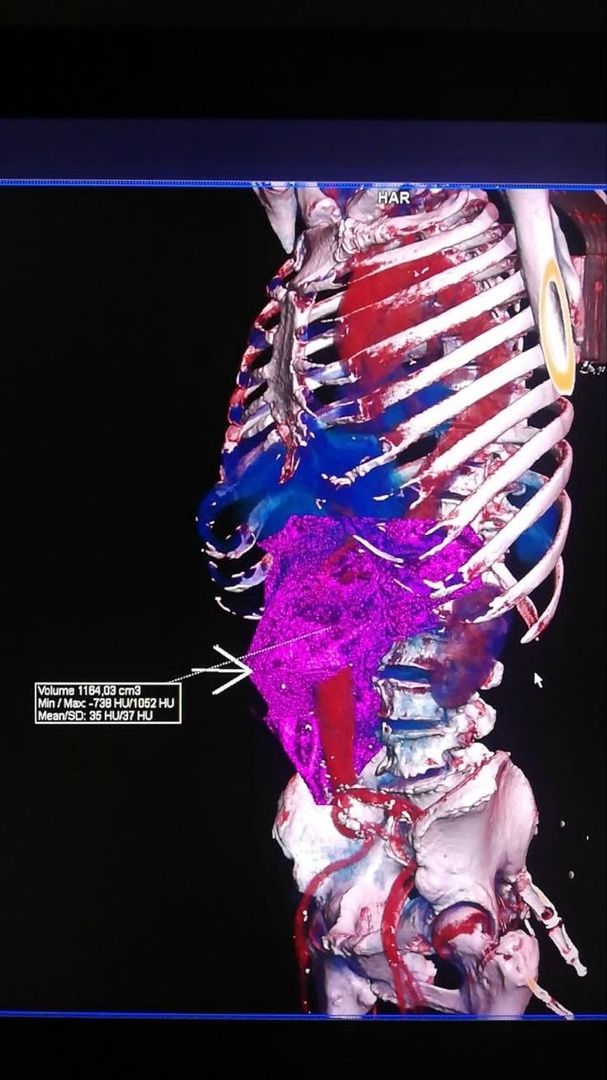 операция, сосудистый хирург, Владимир Никольский, Эдуард Семенов, Алена Матвеевская, Ильяз Мустафоев, анверизма, брюшная аорта,