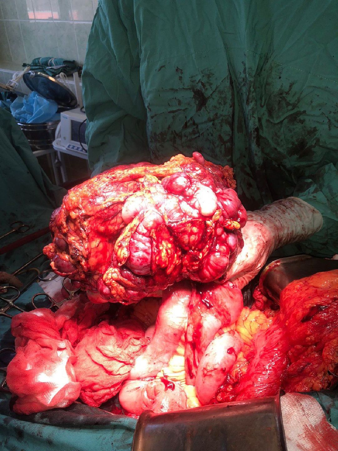 Подольск, медицина, опухоль, здоровье