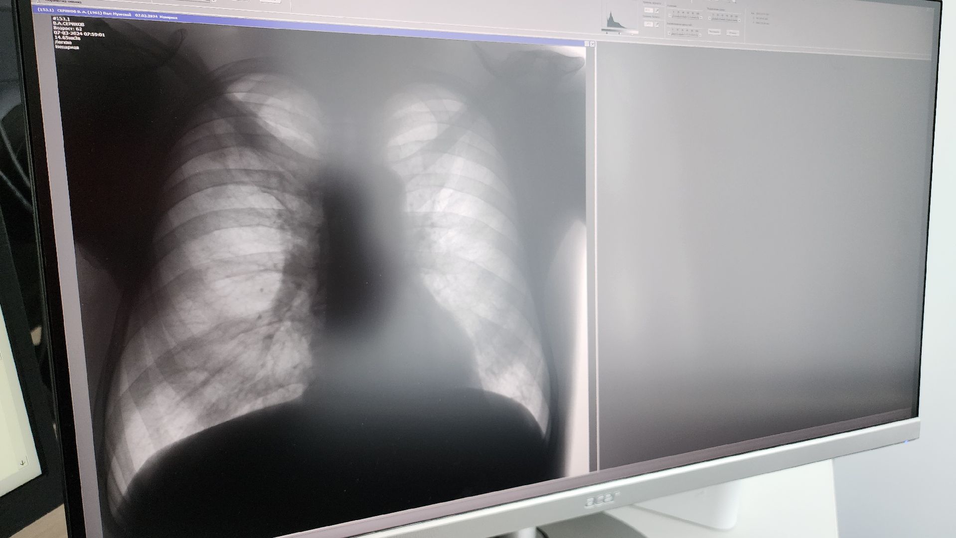 Егорьевск, Подмосковье, Московская область, новое оборудование, егорьевская больница,