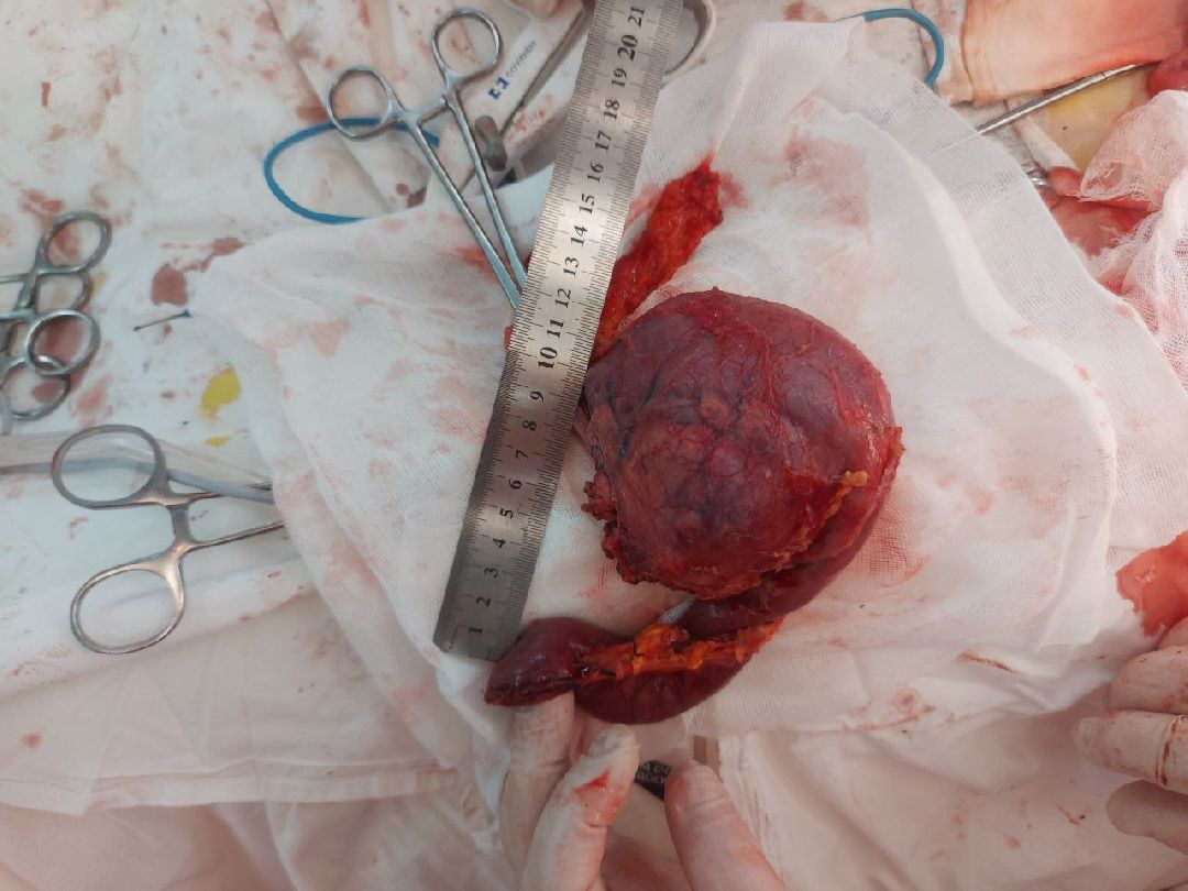 Балашиха, Подмосковье, операция, онкология, Московский областной онкодиспансер