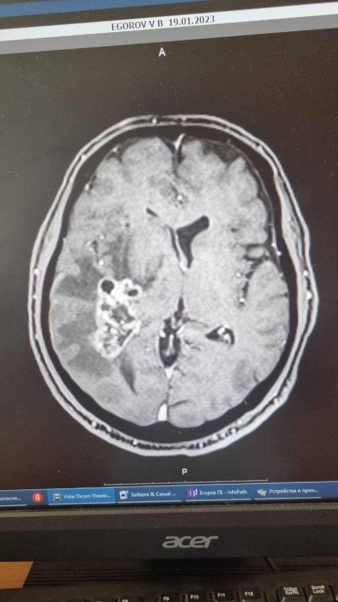 нейрохирургия, операция, опухоль