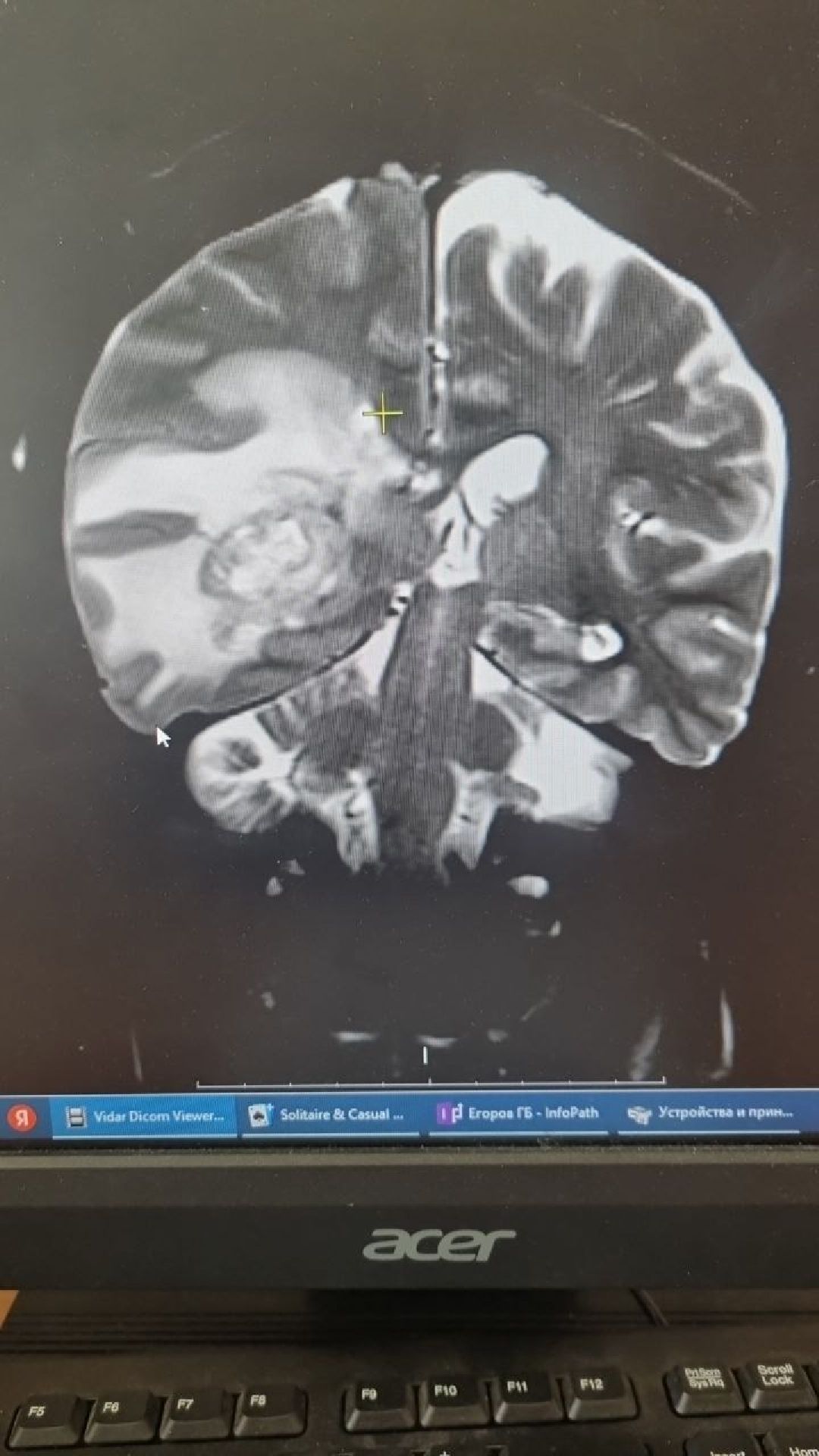 нейрохирургия, операция, опухоль