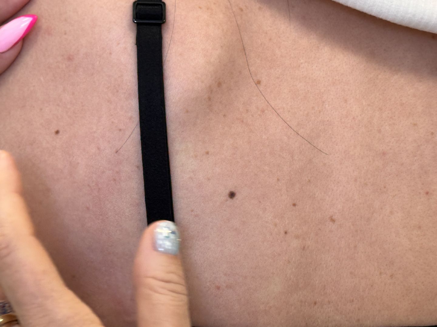 Одинцово, здравоохранение подмосковья, Меланома кожи,