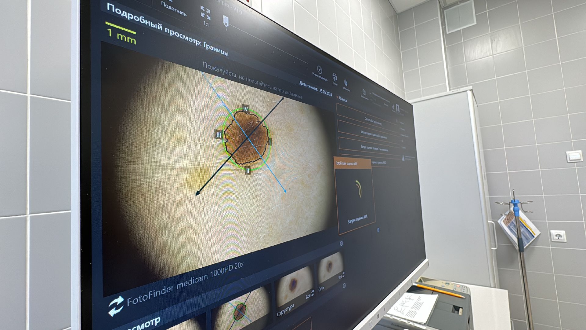 Одинцово, здравоохранение подмосковья, Меланома кожи,