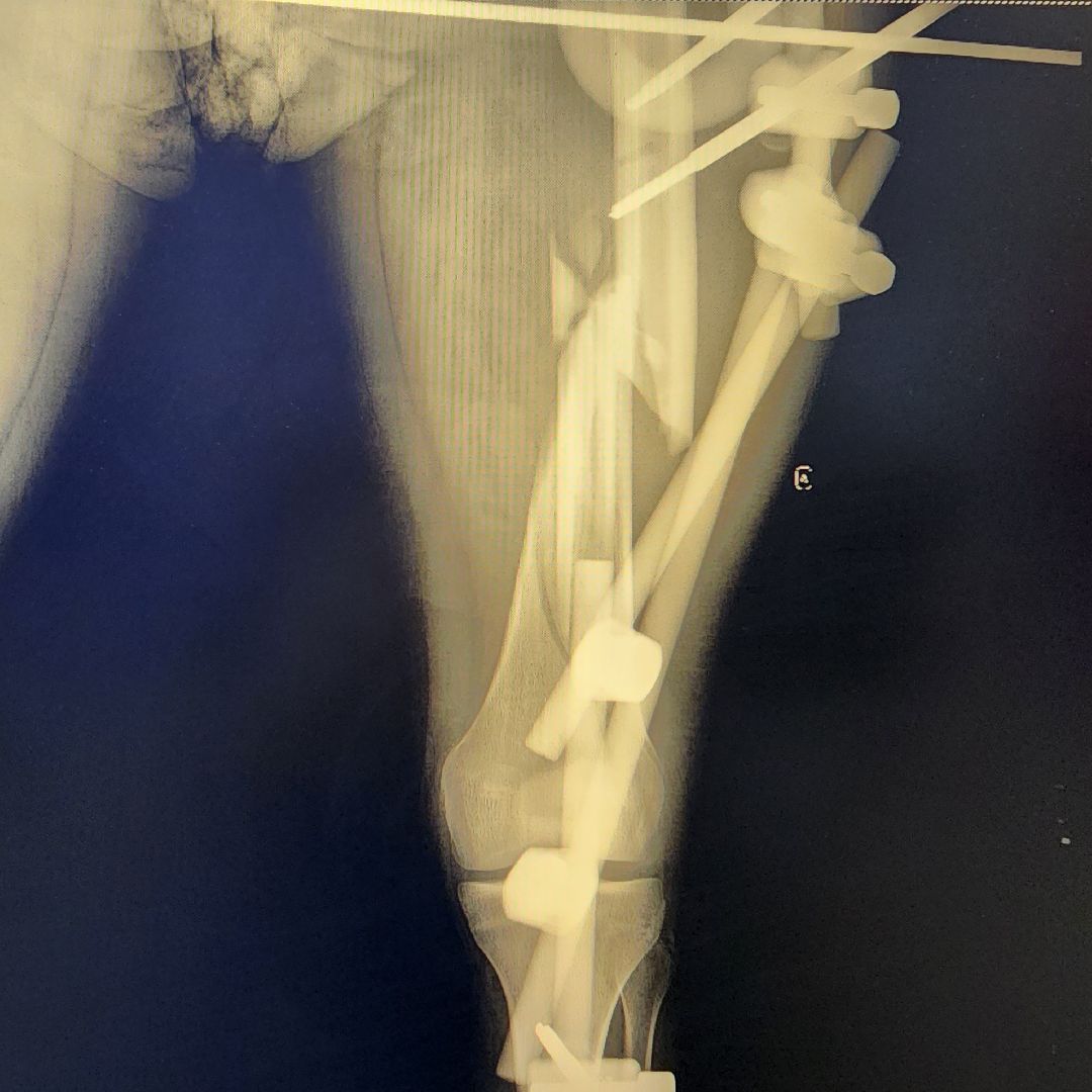Солнечногорск, медицина, травматология, история спасения,