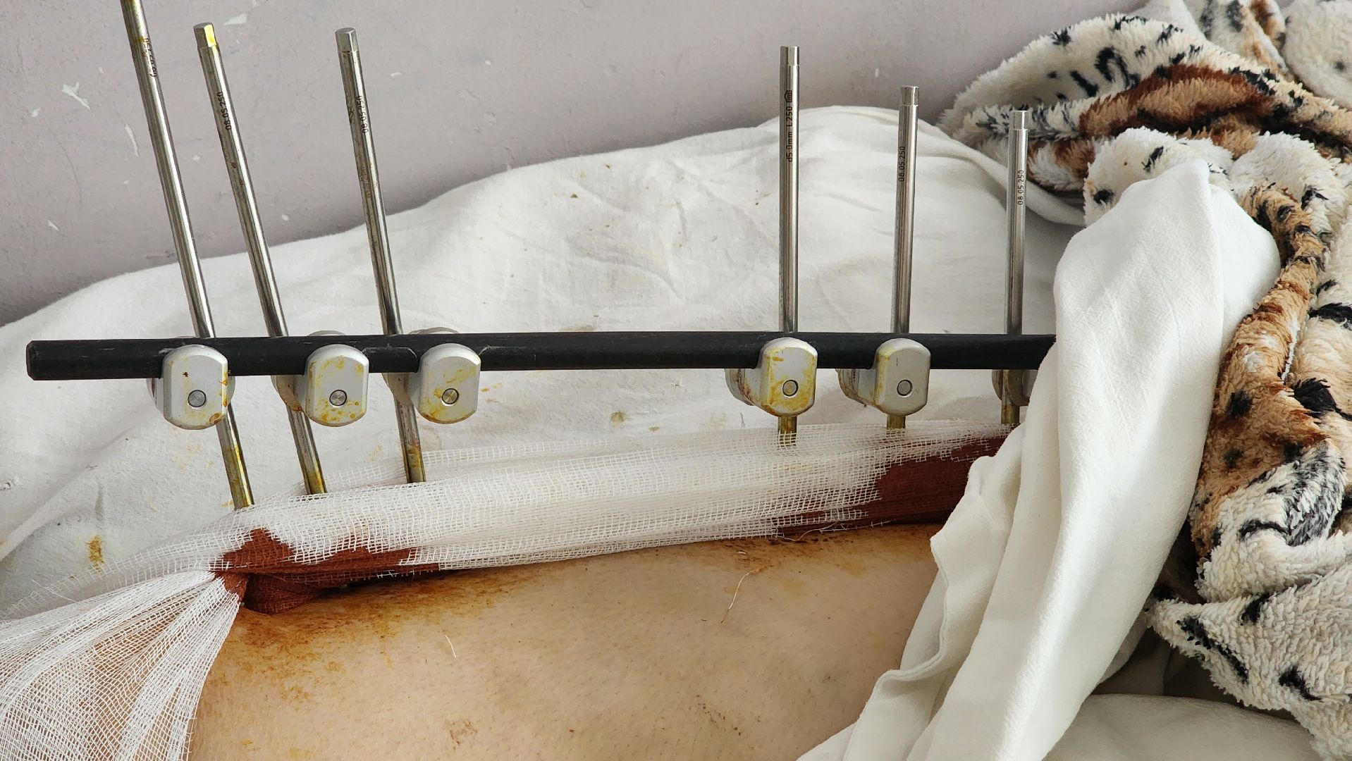 Солнечногорск, медицина, травматология, история спасения,