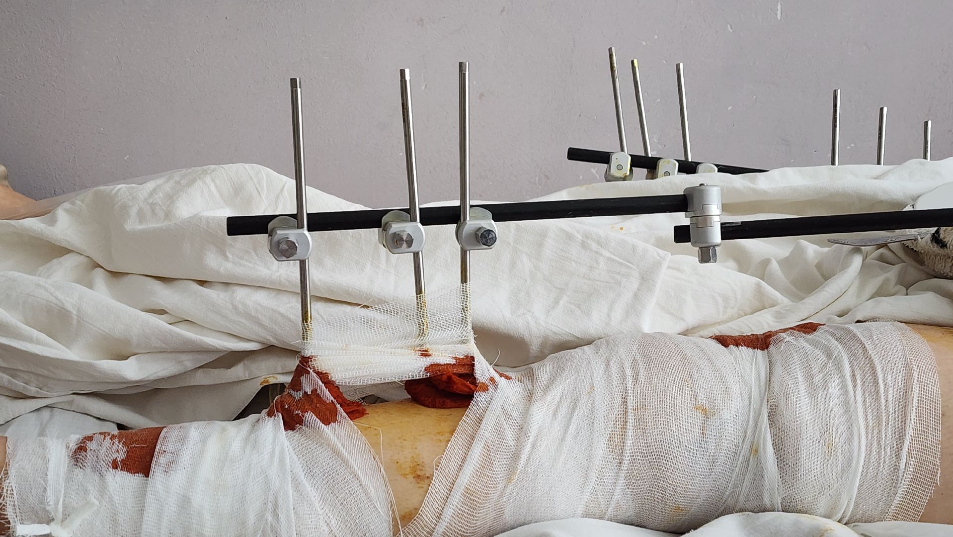 Солнечногорск, медицина, травматология, история спасения,