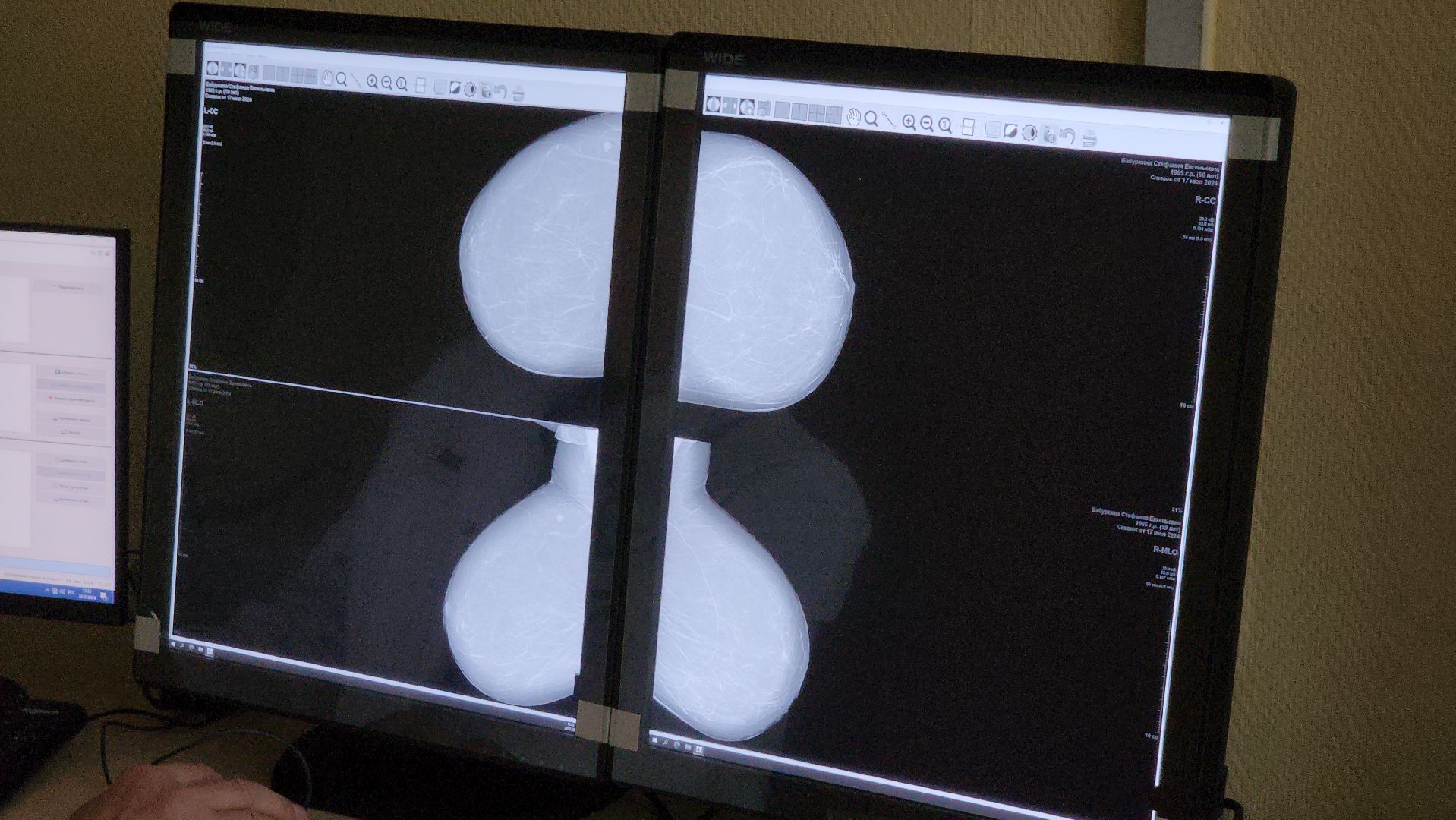 маммограф, маммография, руза, цифровое оборудование, медицина подмосковья, здравоохранение, здравоохранение мо,