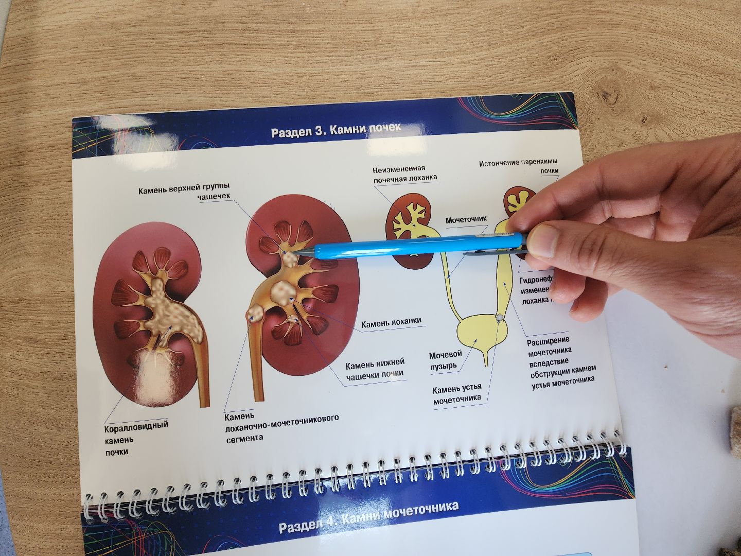 урология, камни в почках, профилактика болезней, советы врачей,