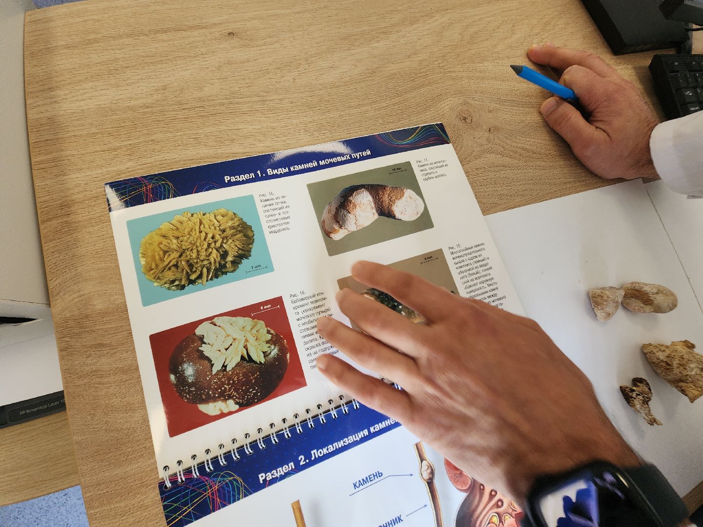 урология, камни в почках, профилактика болезней, советы врачей,