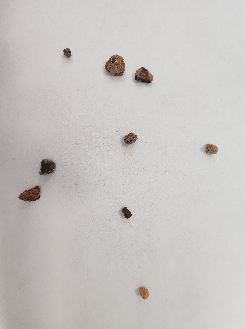 урология, камни в почках, профилактика болезней, советы врачей,