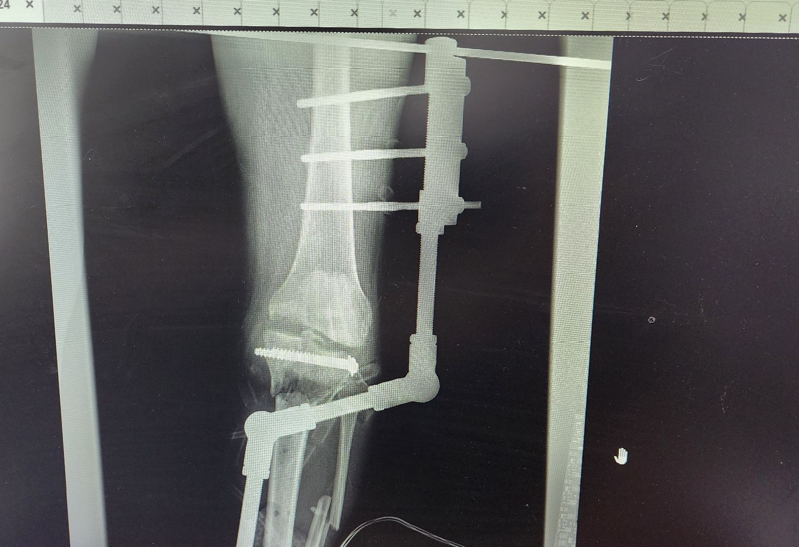 Солнечногорск, медицина, травматология, ДТП,