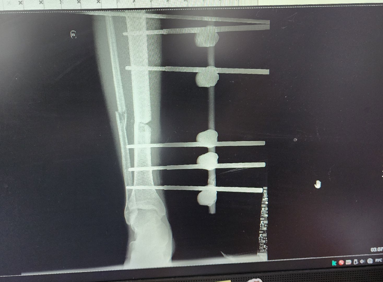 Солнечногорск, медицина, травматология, ДТП,