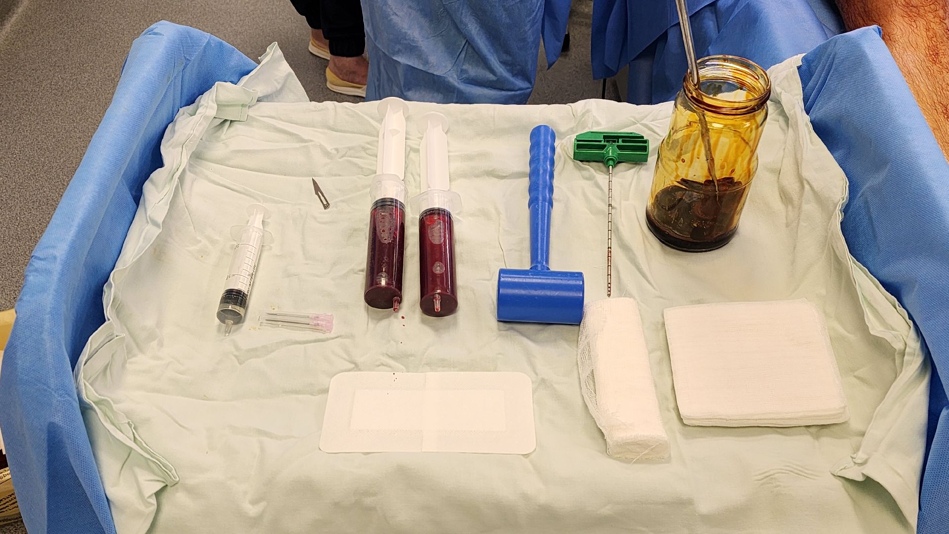 Жуковская ОКБ, травматология, центр травматологи и ортопедии, BMAC-терапия, Бимак, Артем Луценко, костный мозг,