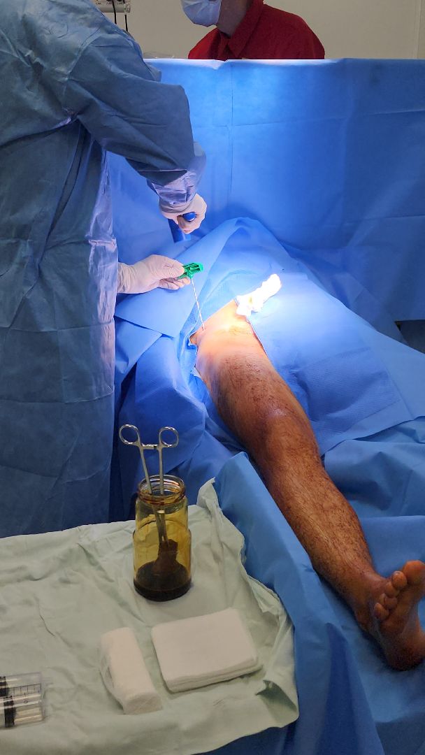 Жуковская ОКБ, травматология, центр травматологи и ортопедии, BMAC-терапия, Бимак, Артем Луценко, костный мозг,