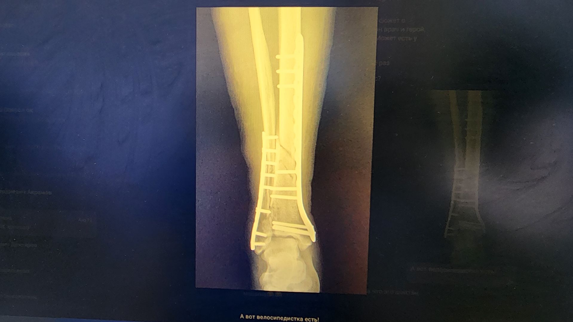 Солнечногорск, медицина, травматология, велосипед,