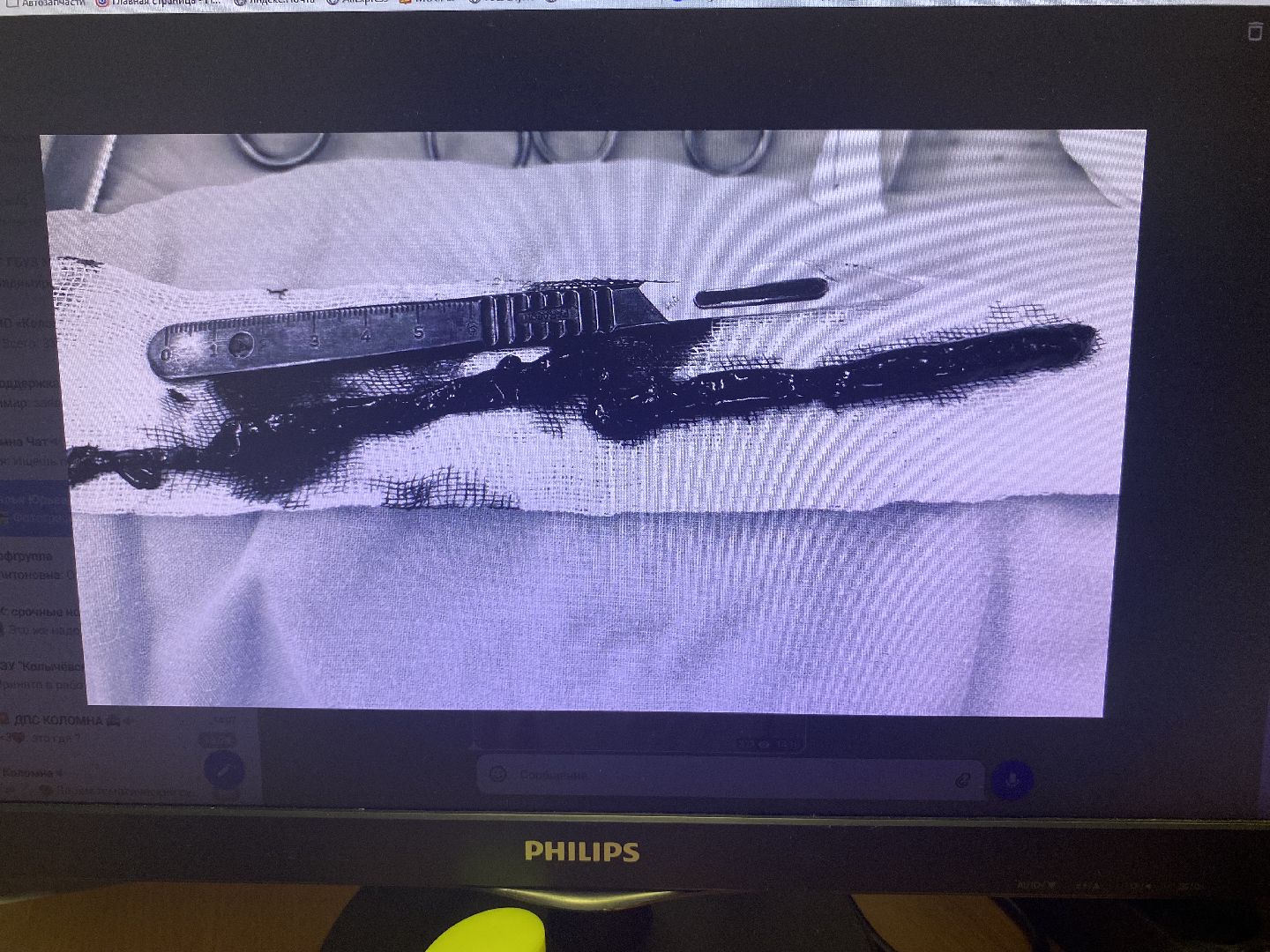 Коломна, Врач сосудистый хирург, коломенская больница, Сложная операция,