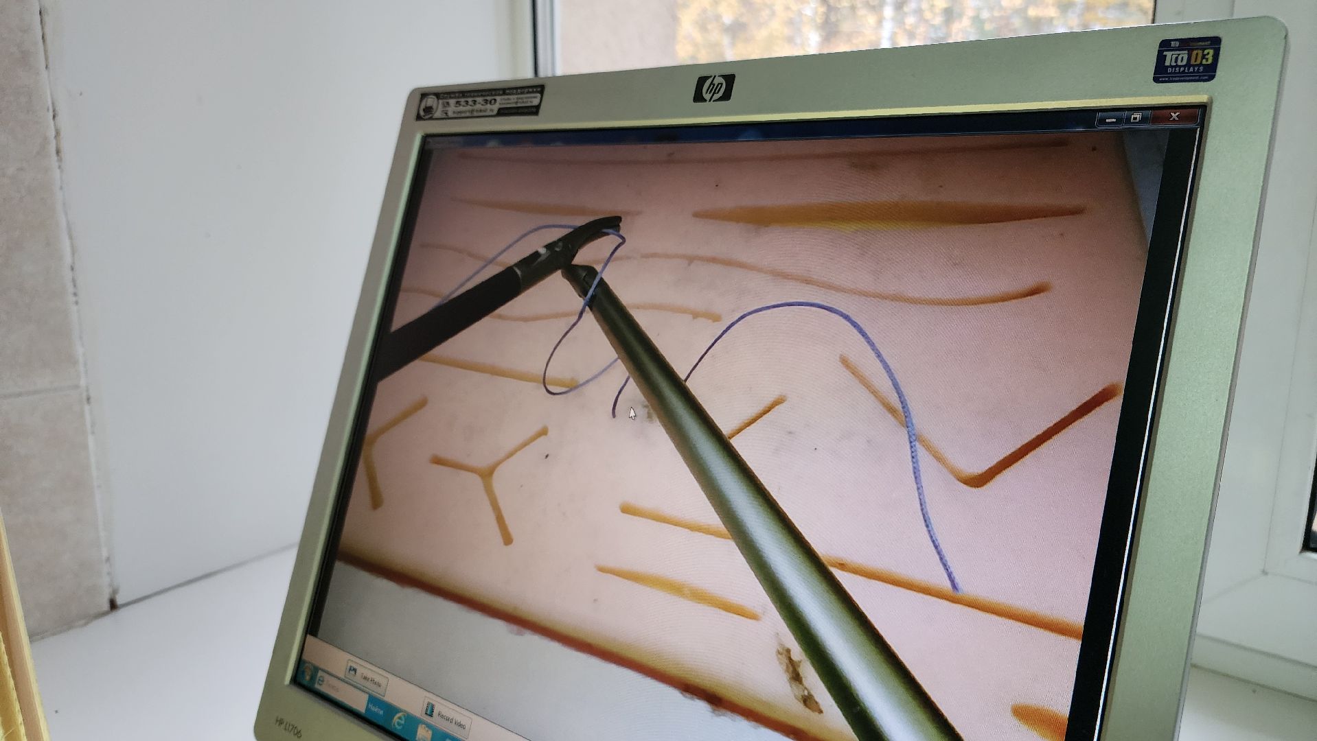 протвино, протвинская хирургия, симулятор лапароскопической операции, протвинская больница, медицина,