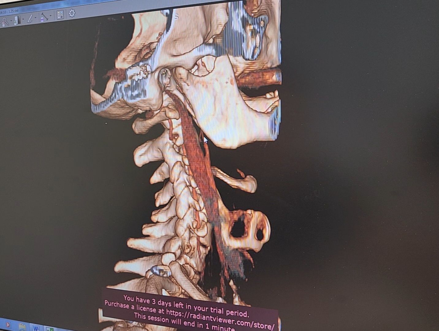 Дубна, фбуз мсч №9 фмба россии, Сосудистый центр, Операция, Профилактика инсульта,