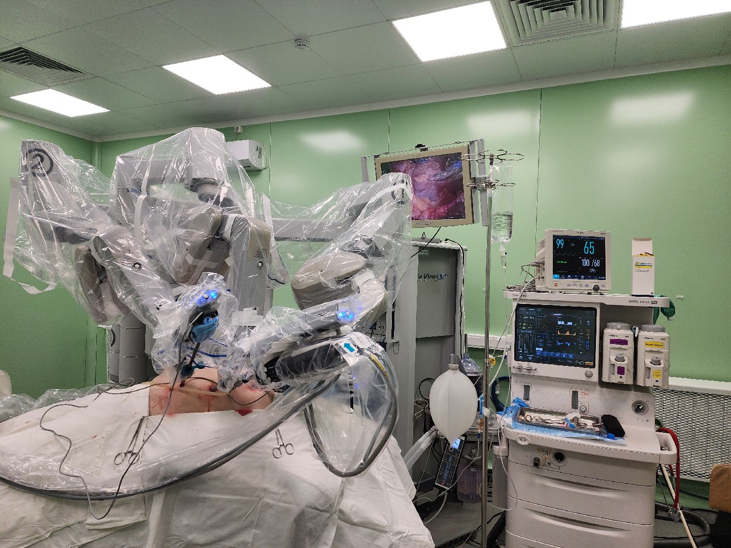 воскресенск, здравоохранение мо, операция, робот da vinci,