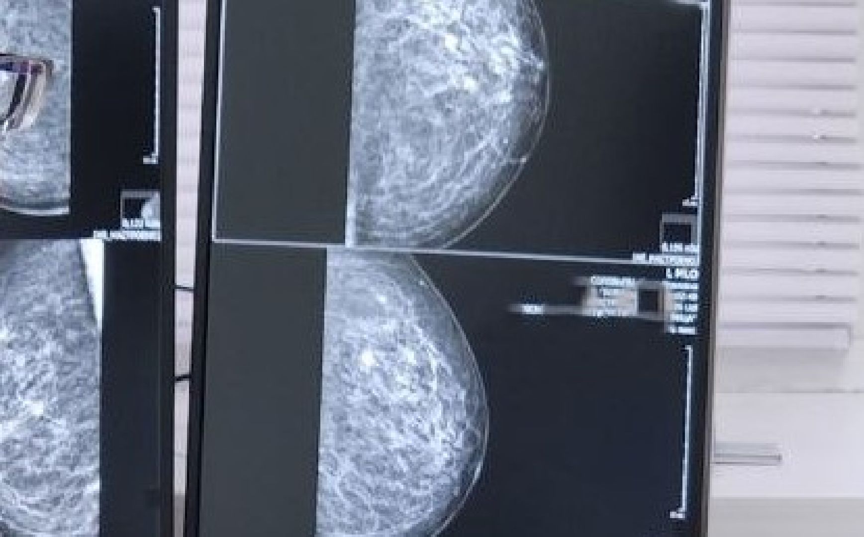 медицина, цифровой маммограф, протвино, диагностика, г о серпухов,