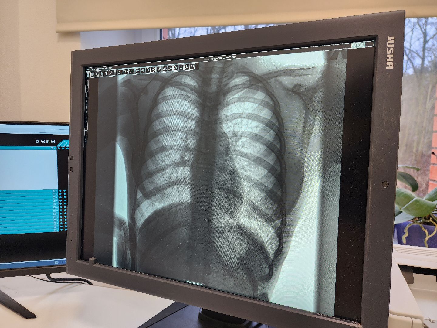 ногинск, медицина, рентген, жители, пациенты, больница,