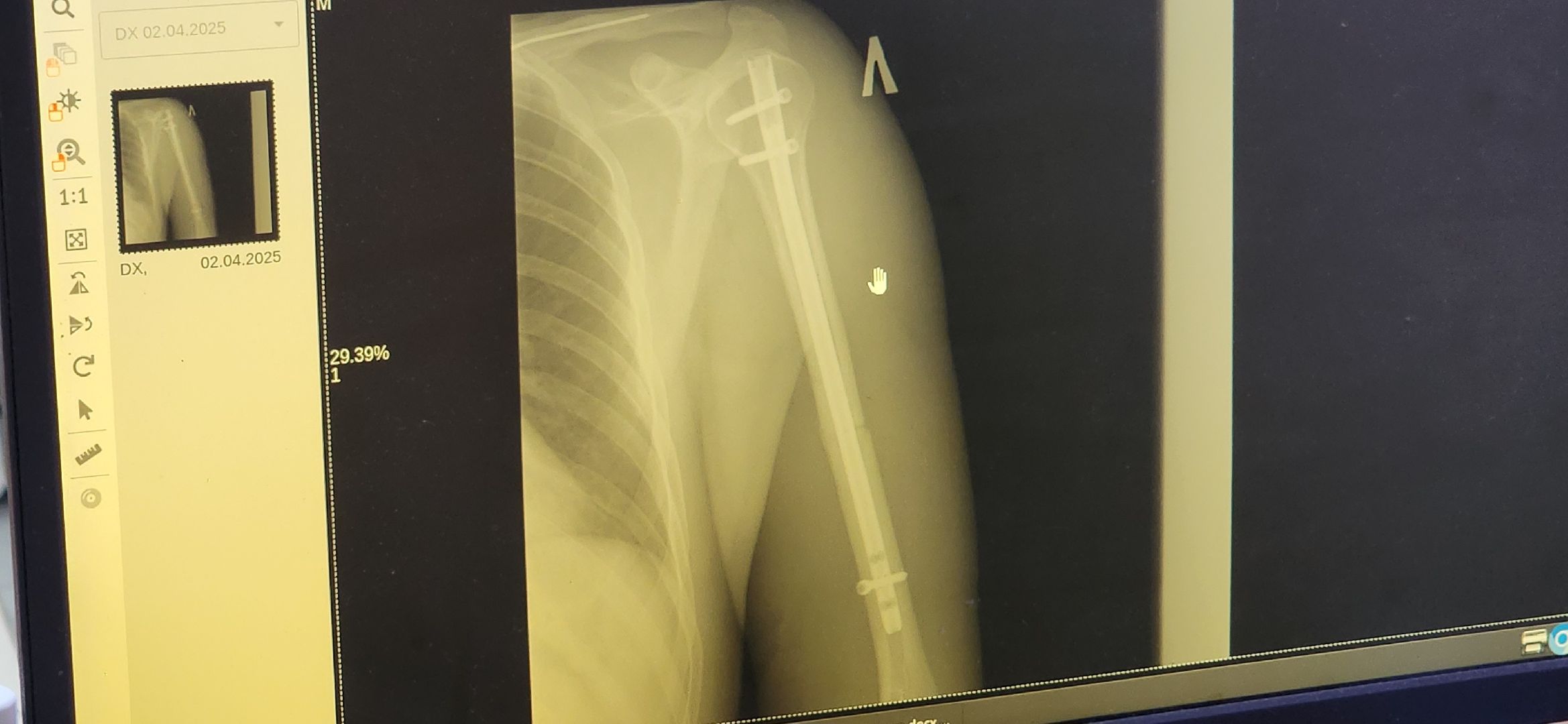 солнечногорск, медицина, травматология, падение с высоты,