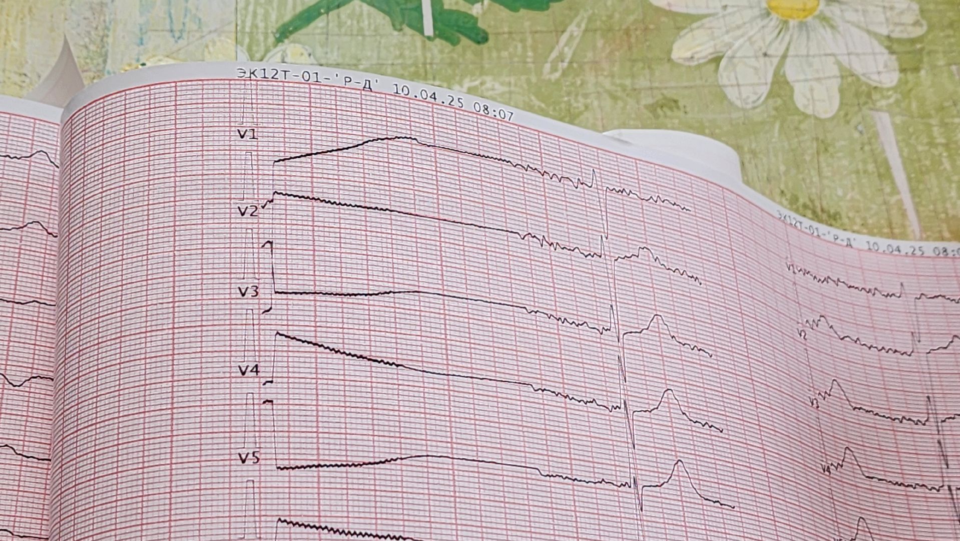 солнечногорск, детская поликлиника, дети с овз, диспансеризация,