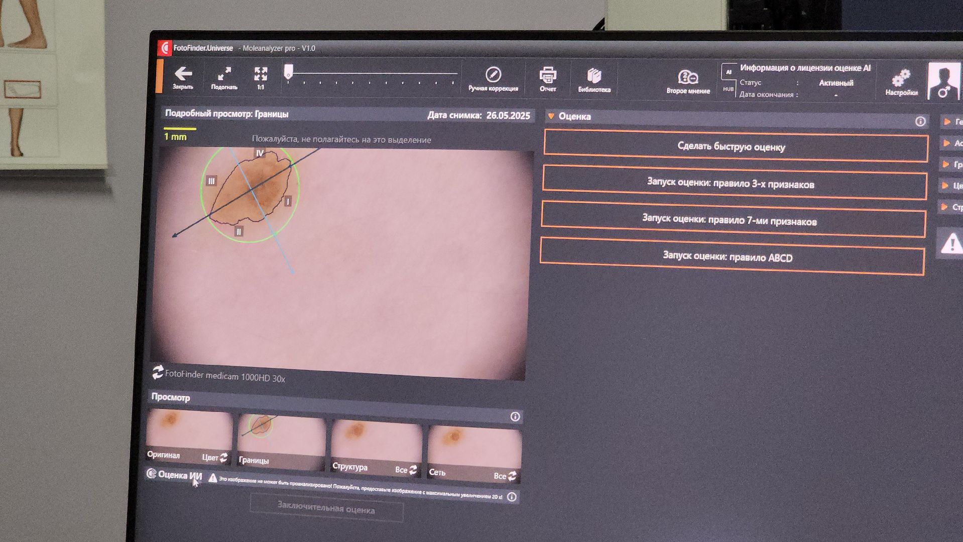 красногорск, медицина, меланома,