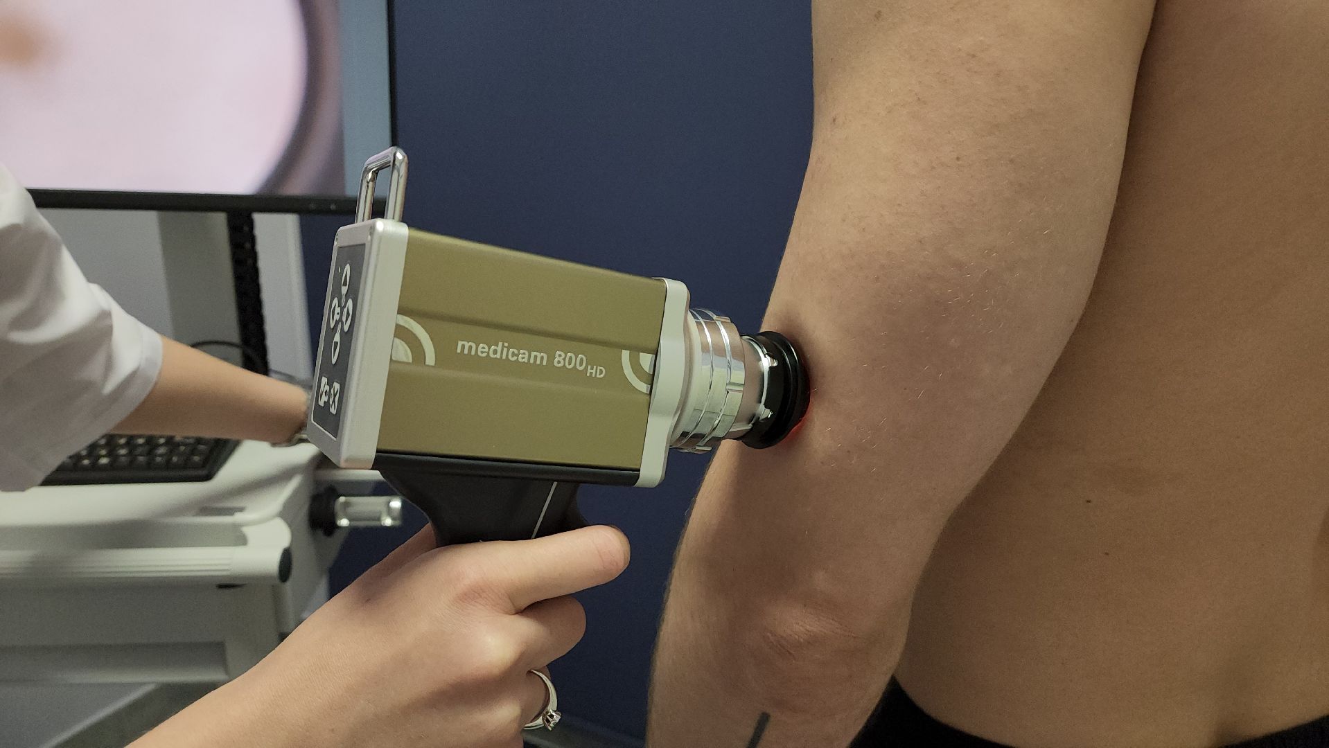 красногорск, медицина, меланома,