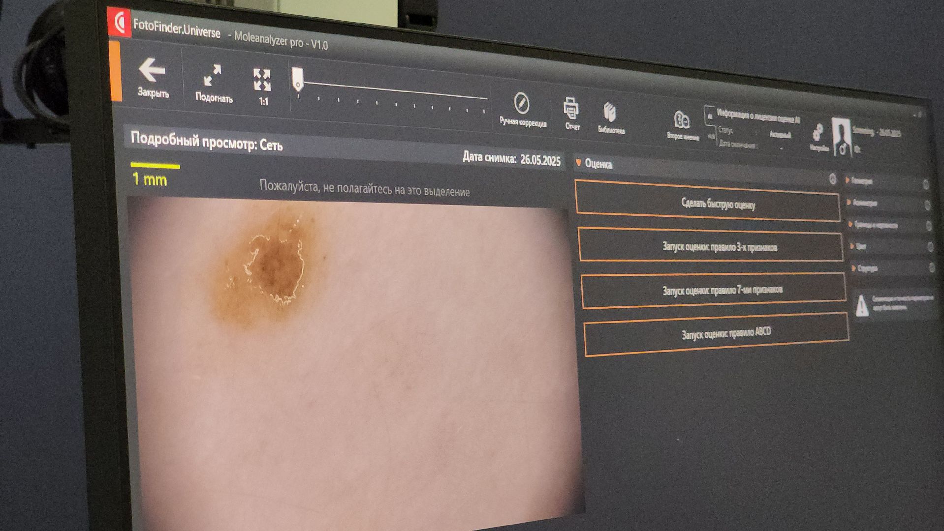 красногорск, медицина, меланома,