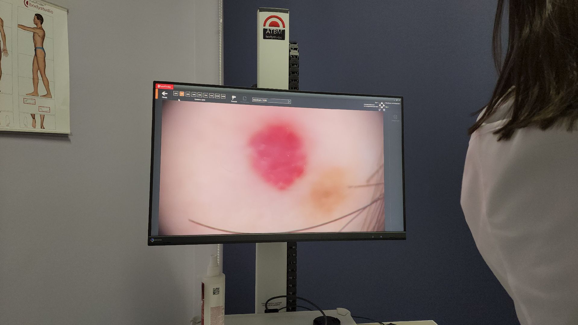 красногорск, медицина, меланома,