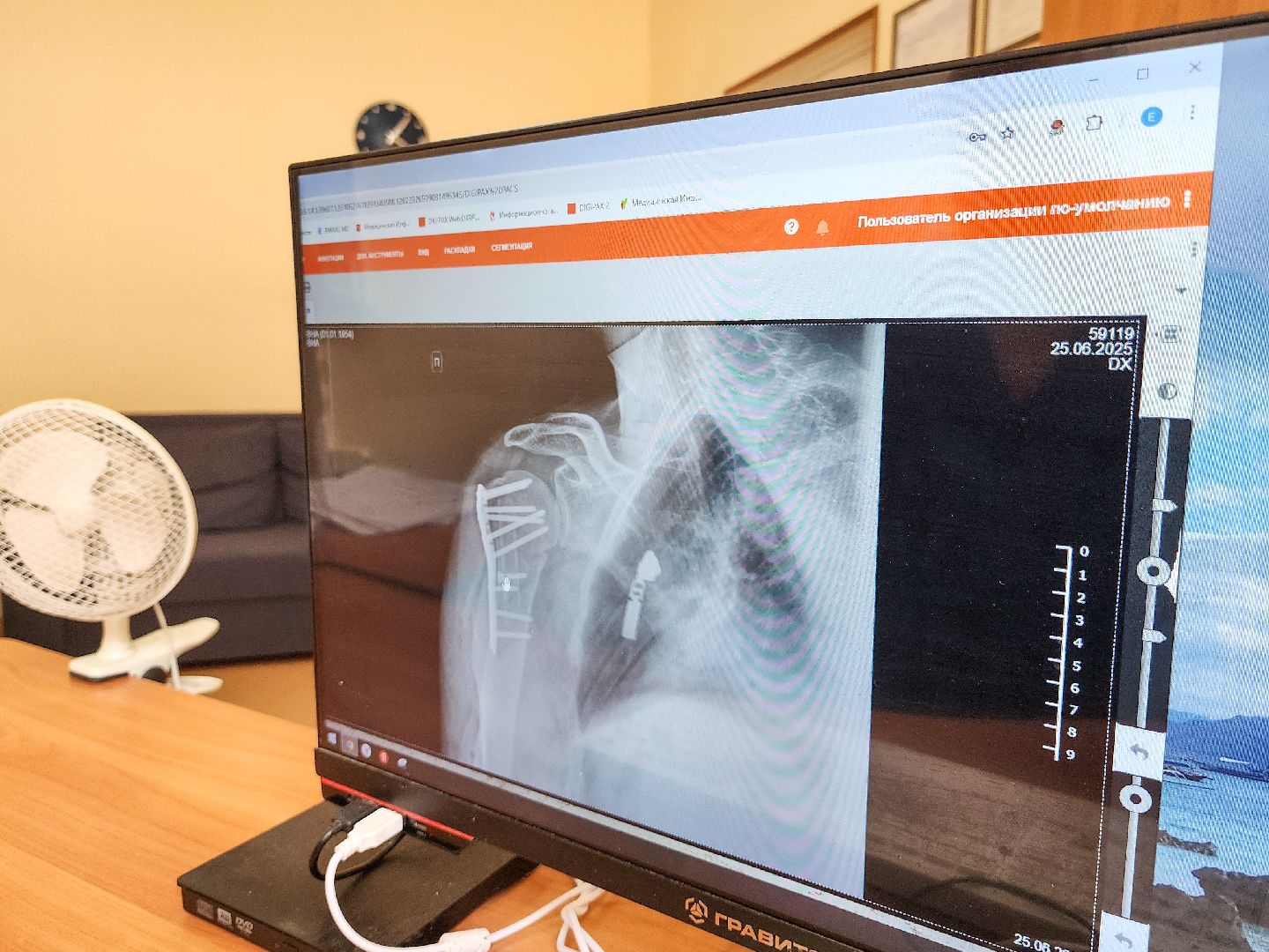 Подольск, Медицина, Лечение переломов, Траматолог, врачи подмосковья, покб,