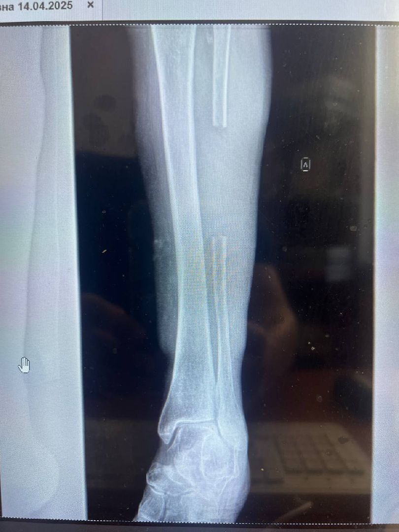 Подольск, Медицина, Лечение переломов, Траматолог, врачи подмосковья, покб,