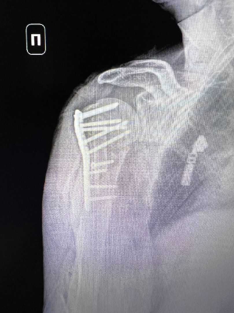 Подольск, Медицина, Лечение переломов, Траматолог, врачи подмосковья, покб,