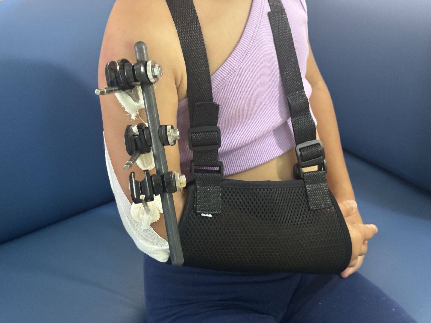 врачи спасли , видновская клиническая больница, перелом руки, врач травматолог-ортопед,