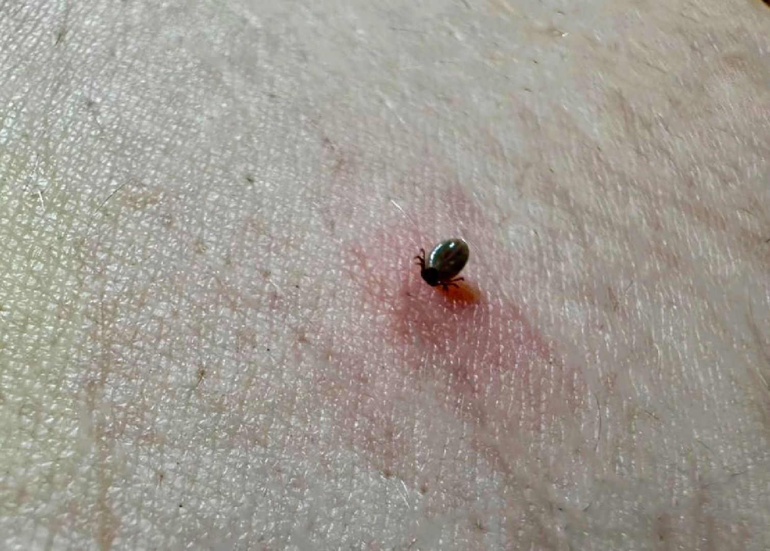 подольск, клещи, Укусы клещей, покб,