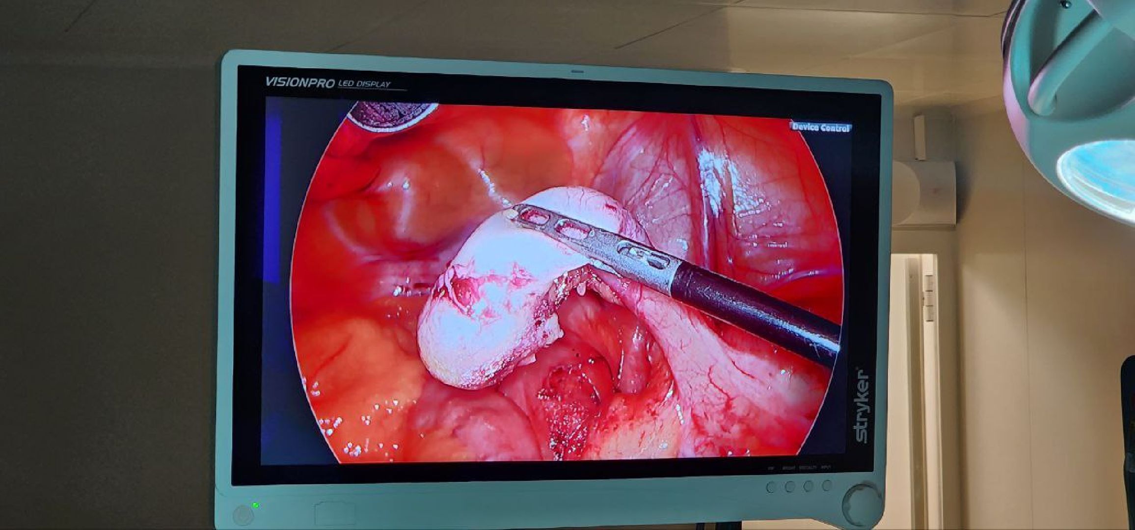 Дмитров, Дмитровская больница, Малоинвазивные операции, Лапароскопическая методика лечения, Минздрав,